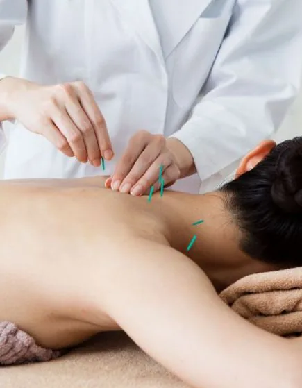 Acupuncture needles placed along a patient's upper back